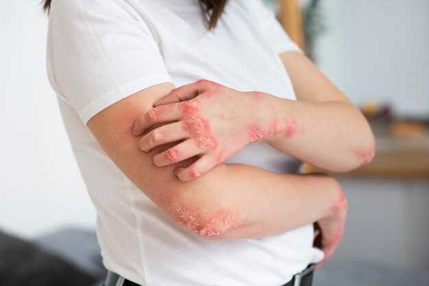 Naltrexone psoriasis